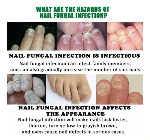 Revitalizante Unhas Anti Hongos