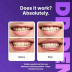 Tiras Blanqueadoras Smilekit